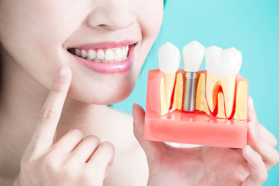 The 5 Benefits of Dental Implants