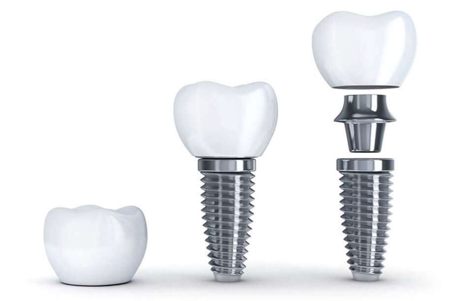 Dental Implants Myths vs. Facts: What You Need to Know