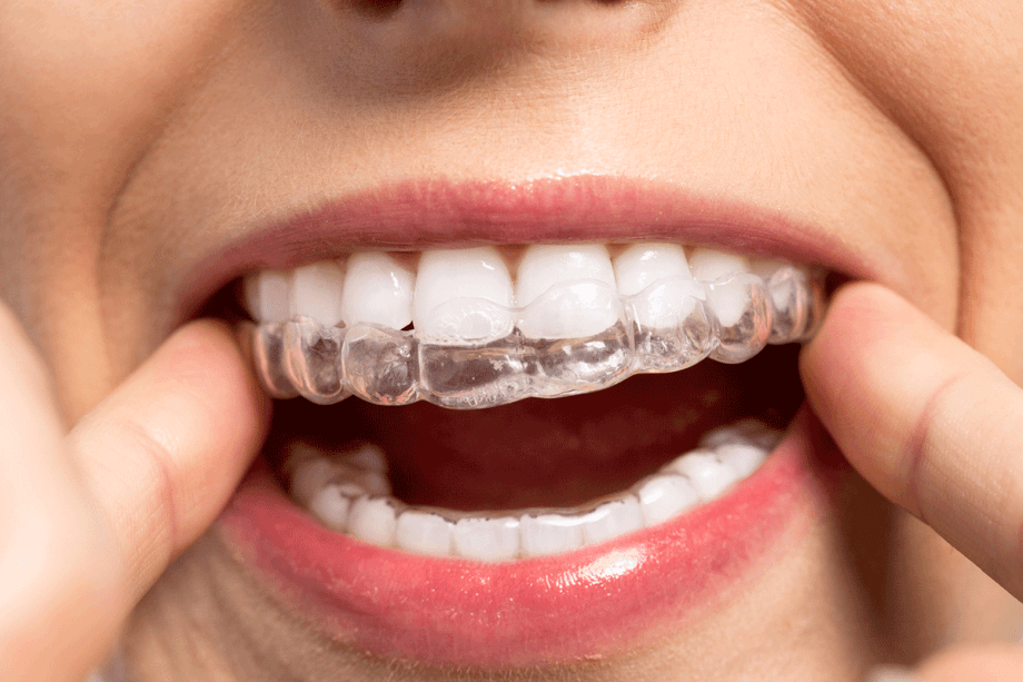 Can Invisalign Fix an Overbite?