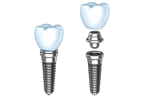 Single Tooth Dental Implants in Waltham