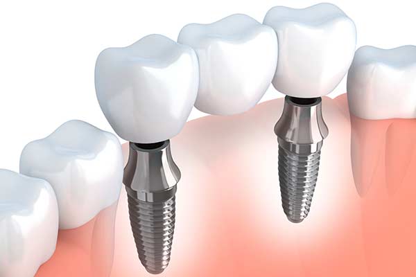 Implant Supported Bridges in Waltham