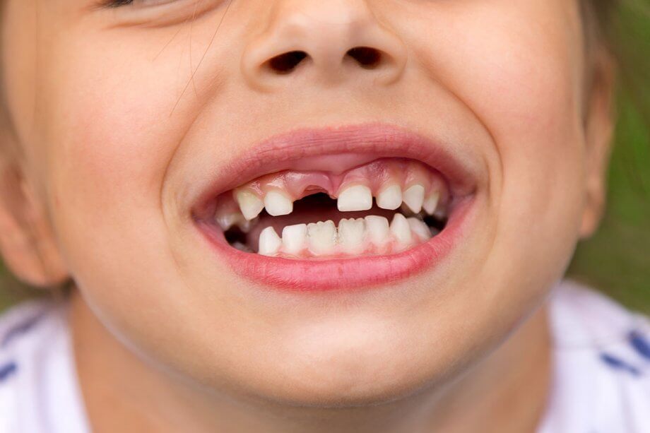 My Child Knocked Out a Tooth! Now What?