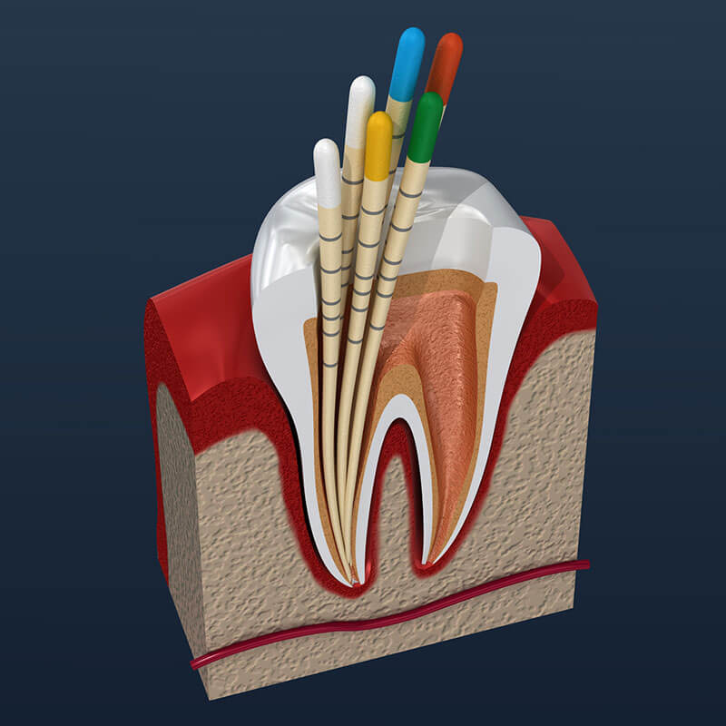 Root Canal Treatment in Waltham, MA