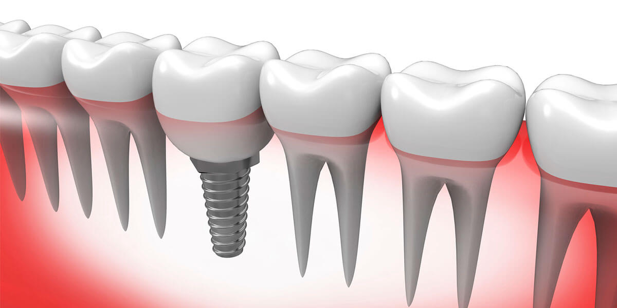 Single Dental Implants in Waltham, MA